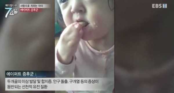 에이퍼트 증후군/사진=EBS